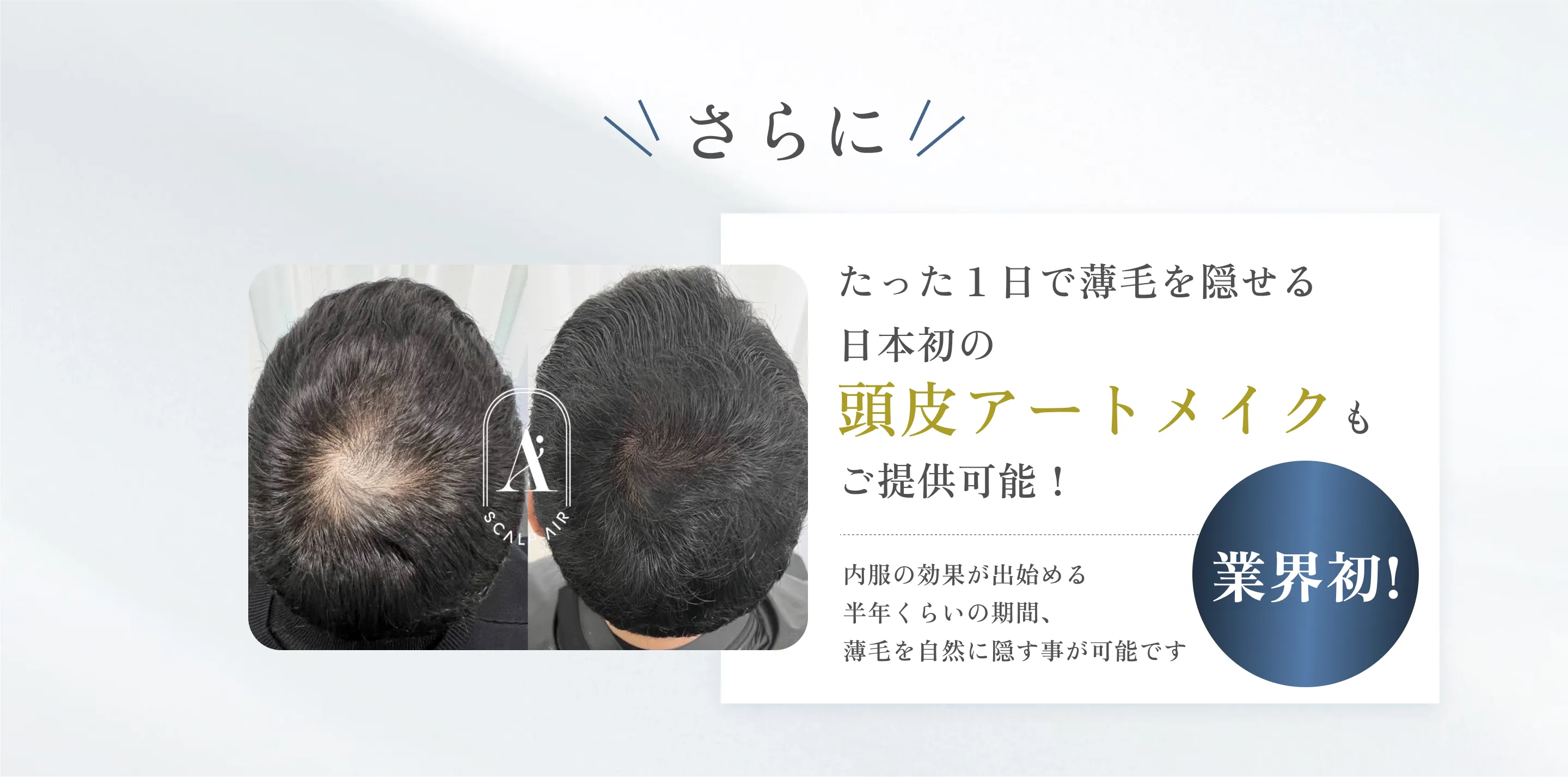 さらに業界初!たった1日で薄毛を隠せる日本初の頭皮アートメイクもご提供可能!内服の効果が出始める半年くらいの期間、薄毛を自然に隠す事が可能です。